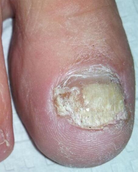 The fungus on the legs