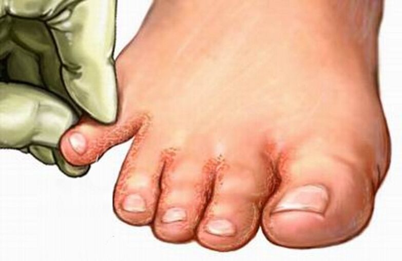 The fungus on the legs