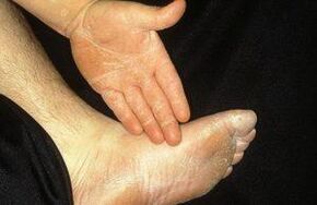 The erased form of mycosis is manifested by peeling