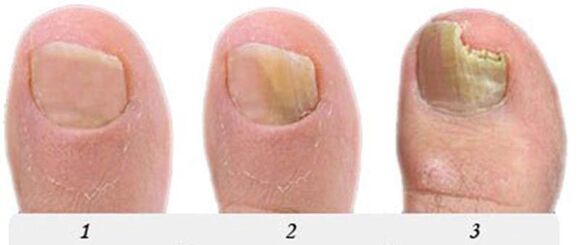 The process of developing the fungus on the thumb