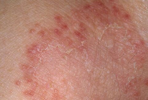 How to quickly cure the fungus, the doctor will tell