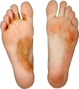 cure the fungus on the finger and not pick it up again