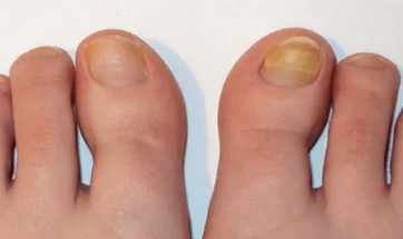 The initial stage of the nail fungus