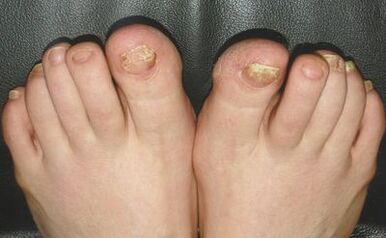 Signs of fungus on the nails