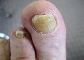 The causes of the appearance of the fungus on the nails