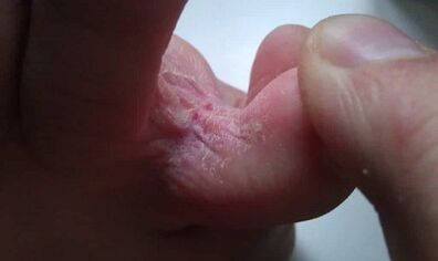Stages of the development of the fungus between the toes