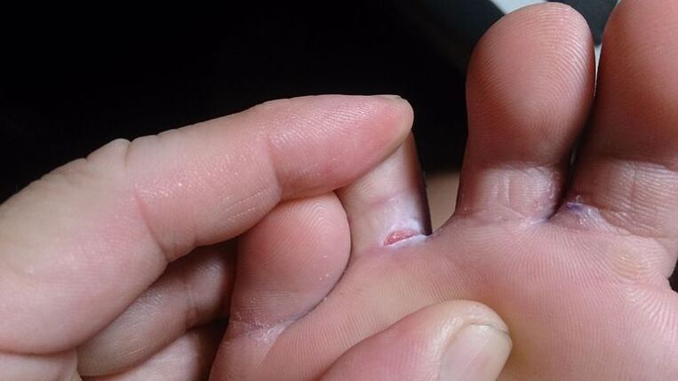Foot fungus