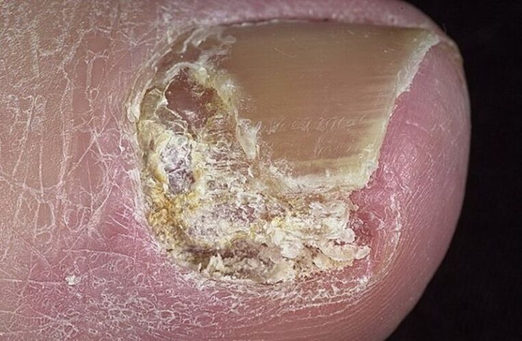 Types of onychomycosis