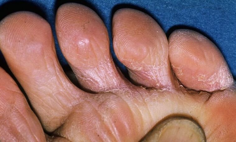 Various types of legs fungus