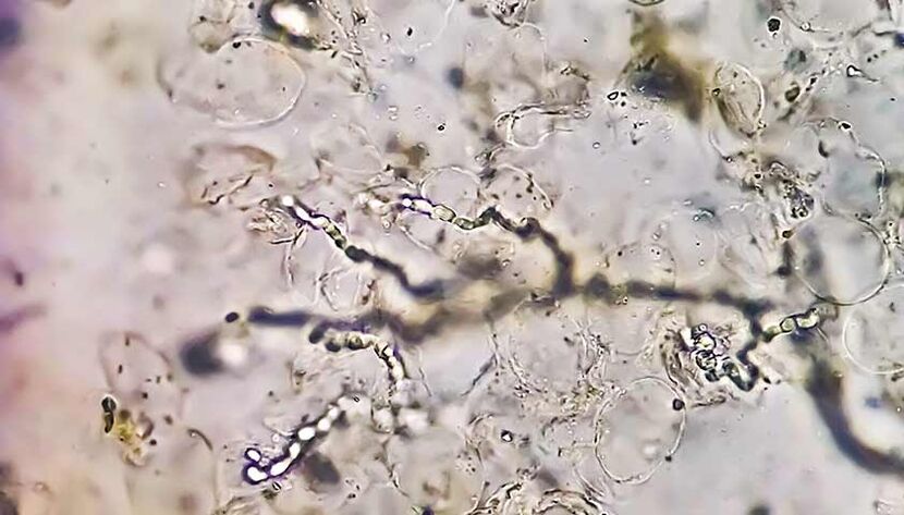 Fungi under a microscope – the culprit in the development of mycosis of the feet