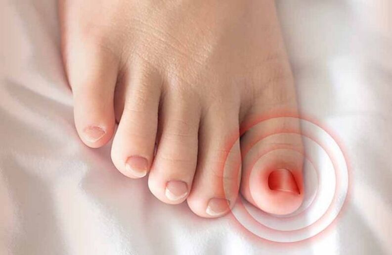 ingrown nail