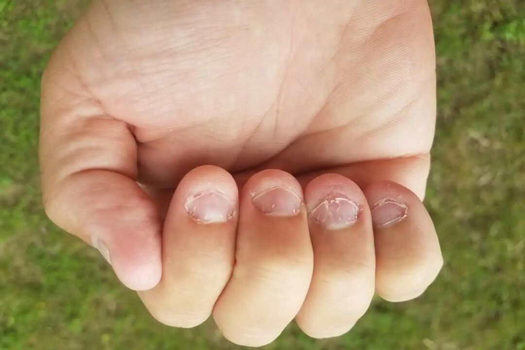 micronychia on nails